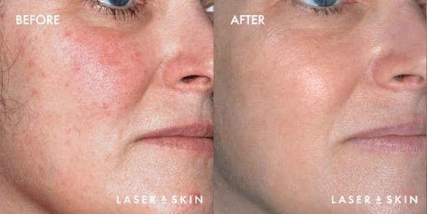 VBeam-Laser-Result-3.jpg