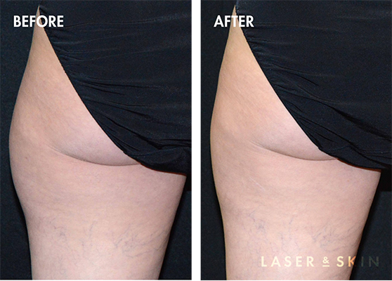 coolsculpting-elite3_400