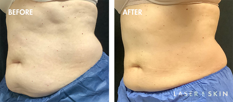 coolsculpting-elite4_400