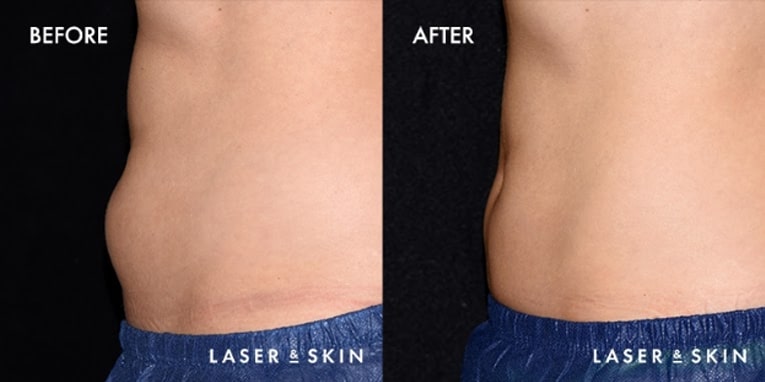 SIX AccuFit body contouring treatments and the results are 🔥 Looking to  tone, tighten and lift with zero downtime? The AccuFit is your…